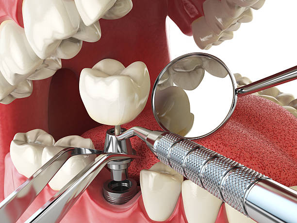 Best Emergency Denture Repair in Annandale, NJ